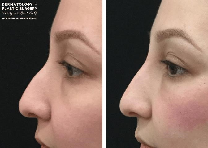 open vs closed rhinoplasty