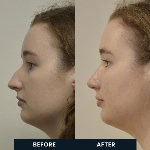 open vs closed rhinoplasty