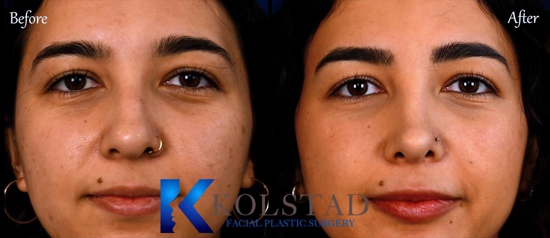 open vs closed rhinoplasty